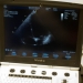 My heart seen with Ultrasound