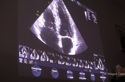 See nitrogen bubbles in the heart using trans-thoracic echocardiography